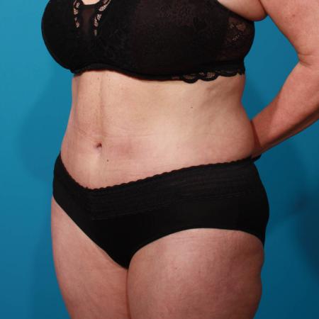 After image 2 Case #103906 - Tummy Tuck with SAL