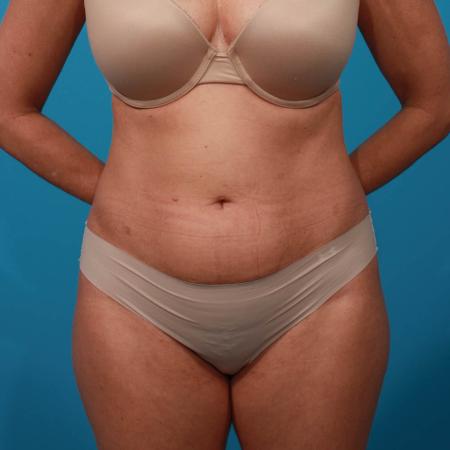 Before image 1 Case #103816 - Tummy Tuck