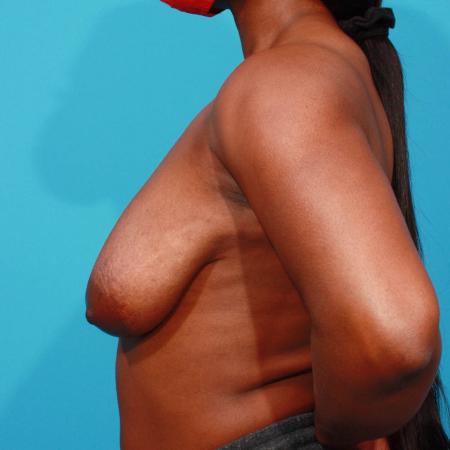 Before image 3 Case #103796 - Breast Lift
