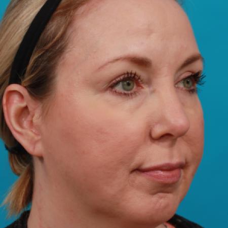 Before image 2 Case #104251 - Chin Augmentation