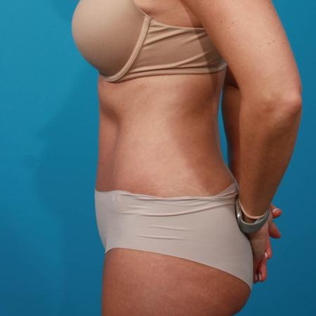 After image 3 Case #103816 - Tummy Tuck