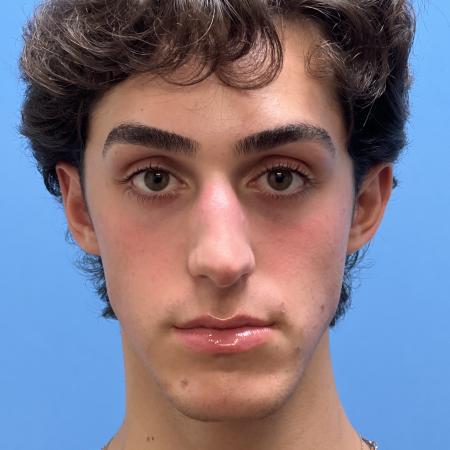 Before image 1 Case #104516 - 19 year old male -  Open Septo-Rhinoplasty - 
