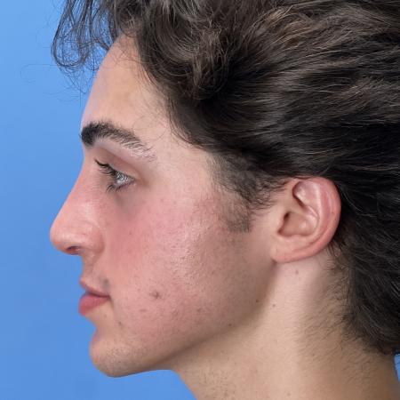 After image 3 Case #104516 - 19 year old male -  Open Septo-Rhinoplasty - 