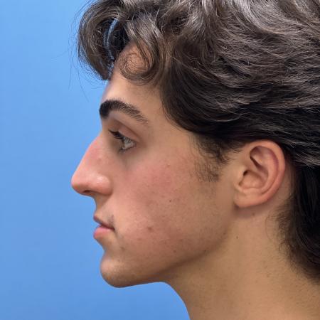 Before image 3 Case #104516 - 19 year old male -  Open Septo-Rhinoplasty - 