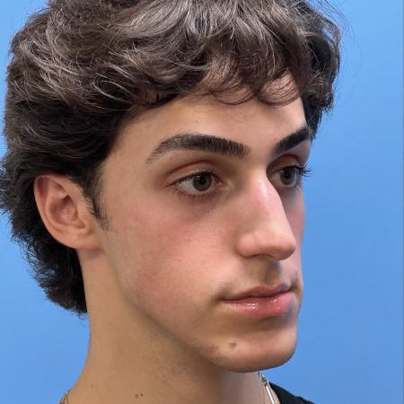 Before image 2 Case #104516 - 19 year old male -  Open Septo-Rhinoplasty - 