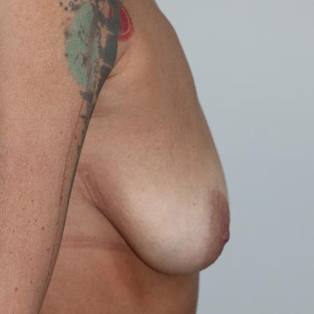 Before image 3 Case #105041 - Autoaugmentation Mastopexy