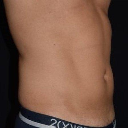Before image 4 Case #105266 - Male Liposuction