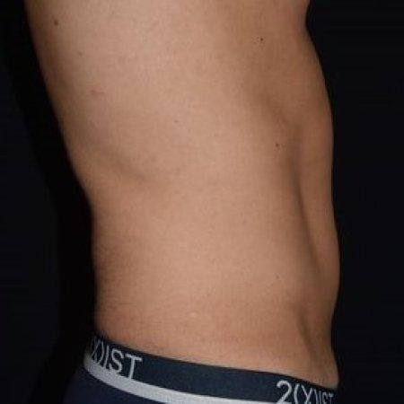 Before image 5 Case #105266 - Male Liposuction