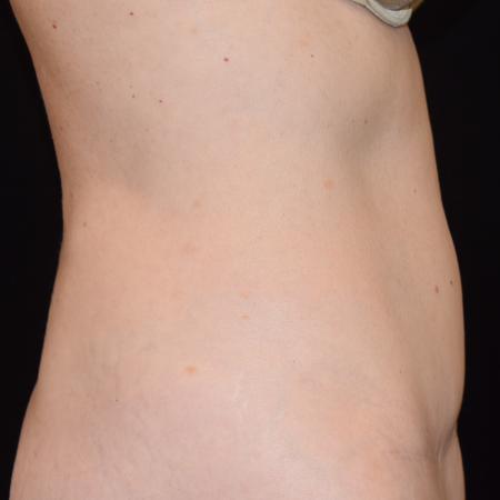 After image 4 Case #105241 - Mini Abdominoplasty with Liposuction