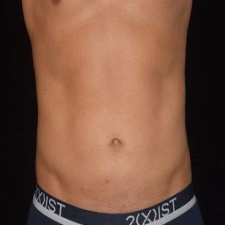 After image 2 Case #105266 - Male Liposuction