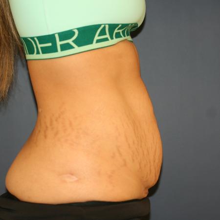 Before image 3 Case #105371 - Abdominoplasty (Tummy Tuck)