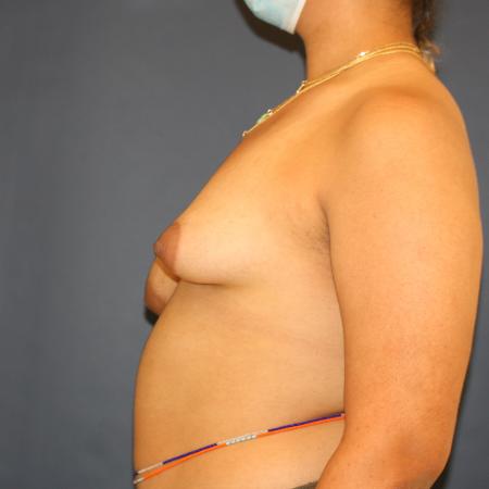 Before image 5 Case #105306 - Breast Asymmetry