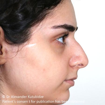 Before image 5 Case #105221 - Primary Septorhinoplasty