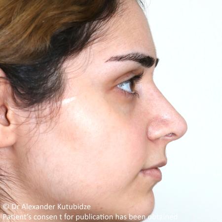 After image 5 Case #105221 - Primary Septorhinoplasty