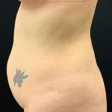 Before image 3 Case #105241 - Mini Abdominoplasty with Liposuction