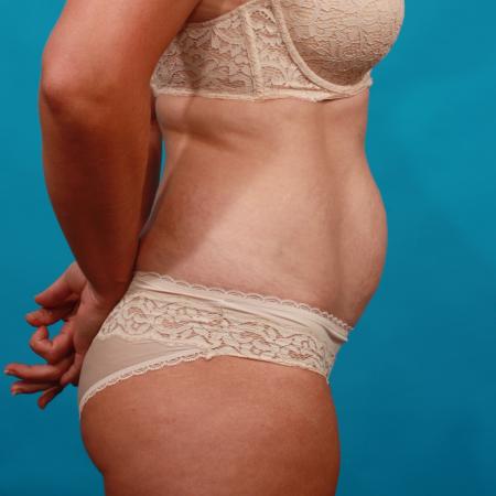 Before image 3 Case #104071 - Tummy Tuck with SAL
