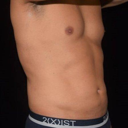 After image 4 Case #105266 - Male Liposuction
