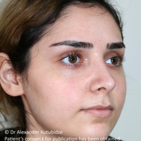 After image 3 Case #105221 - Primary Septorhinoplasty