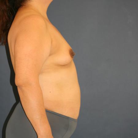 Before image 3 Case #105346 - Mommy Makeover