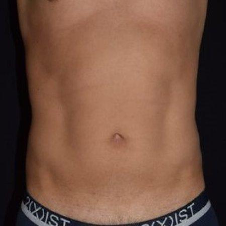 Before image 2 Case #105266 - Male Liposuction