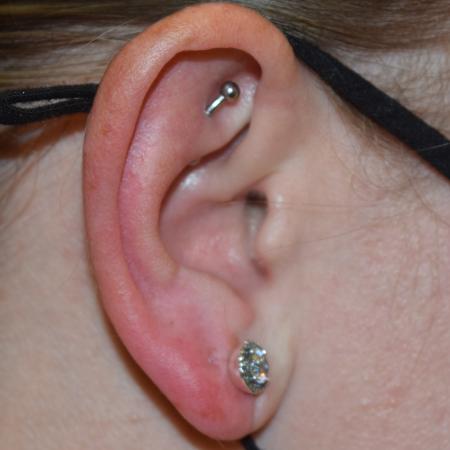 After image 2 Case #105246 - Earlobe Repair