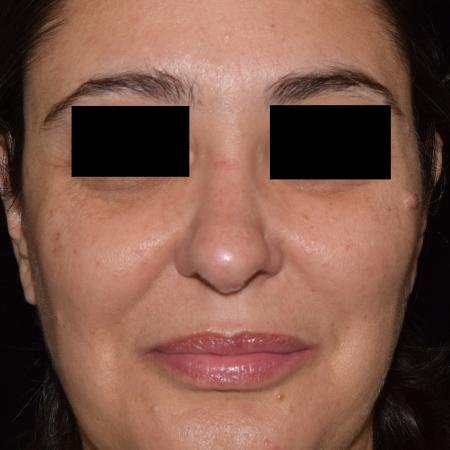 Before image 2 Case #105261 - Mole Excision