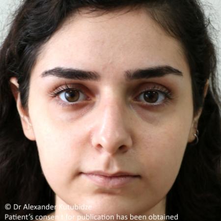 Before image 1 Case #105221 - Primary Septorhinoplasty