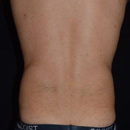 Before image 1 Case #105266 - Male Liposuction