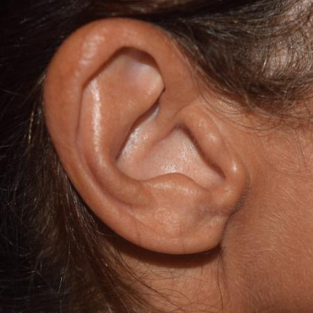 Ear Surgery Plastic Surgery Photos