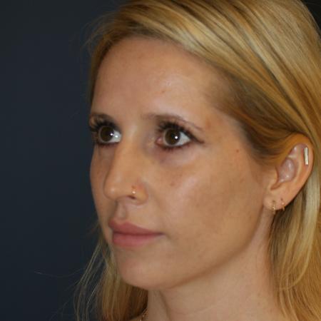 Before image 2 Case #105341 - Revision Septo-Rhinoplasty