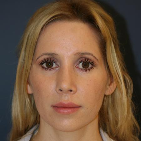 After image 1 Case #105341 - Revision Septo-Rhinoplasty