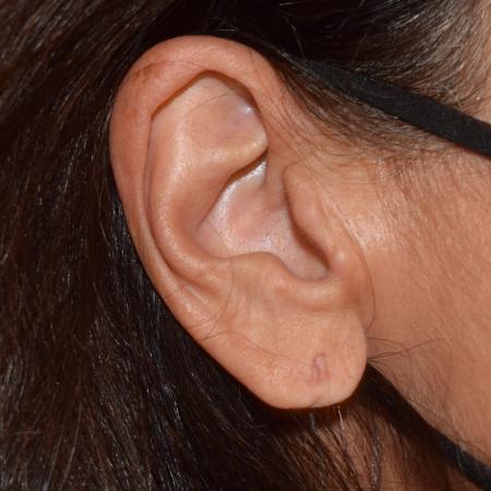 Before image 1 Case #105251 - Earlobe Reduction & Repair