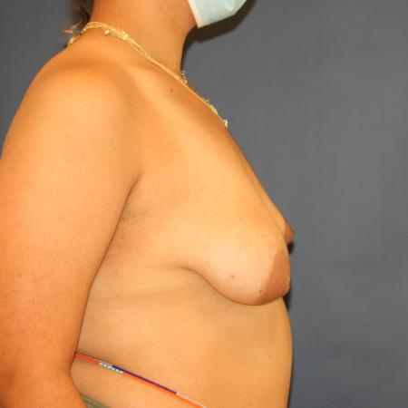 Before image 3 Case #105306 - Breast Asymmetry