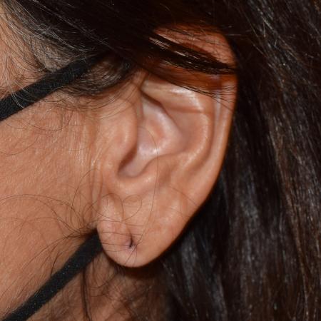 Before image 2 Case #105251 - Earlobe Reduction & Repair