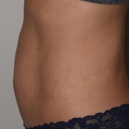 After image 2 Case #105271 - Liposuction, Cellfina, BodyTite & Morpheus8