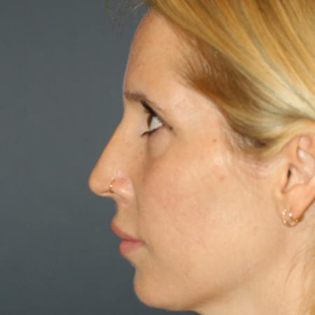 Before image 3 Case #105341 - Revision Septo-Rhinoplasty