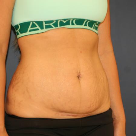 Before image 2 Case #105371 - Abdominoplasty (Tummy Tuck)