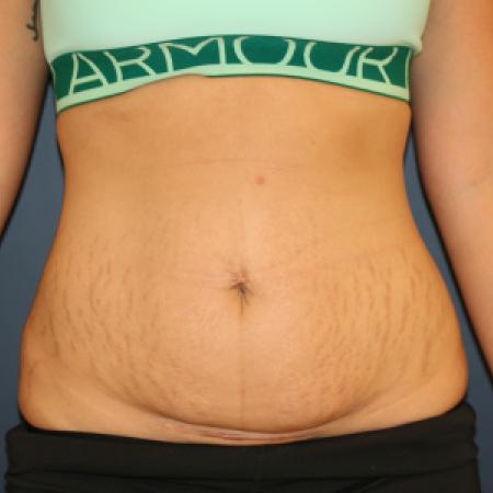 Before image 1 Case #105371 - Abdominoplasty (Tummy Tuck)
