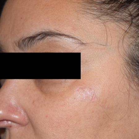 After image 1 Case #105261 - Mole Excision