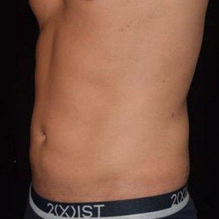 After image 3 Case #105266 - Male Liposuction