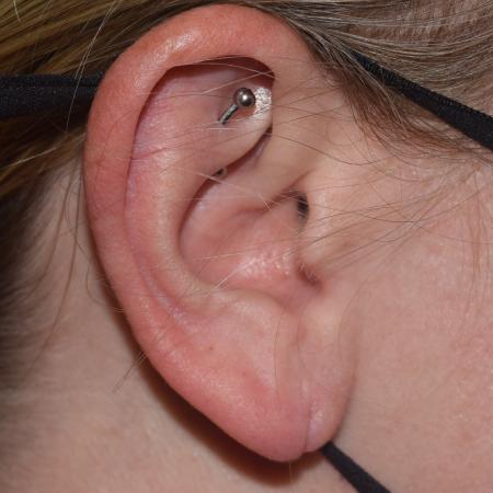 Before image 2 Case #105246 - Earlobe Repair