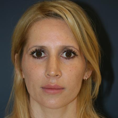 Before image 1 Case #105341 - Revision Septo-Rhinoplasty