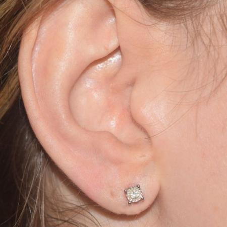 After image 2 Case #105276 - Repair Of Split Earlobe