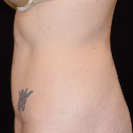 After image 3 Case #105241 - Mini Abdominoplasty with Liposuction