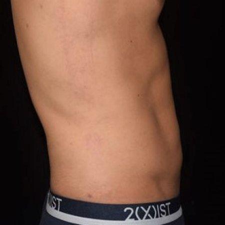 After image 5 Case #105266 - Male Liposuction