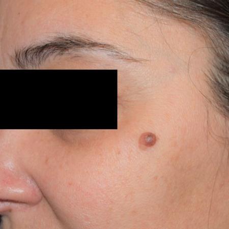 Before image 1 Case #105261 - Mole Excision