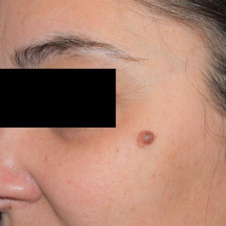 Before image 1 Case #105261 - Mole Excision