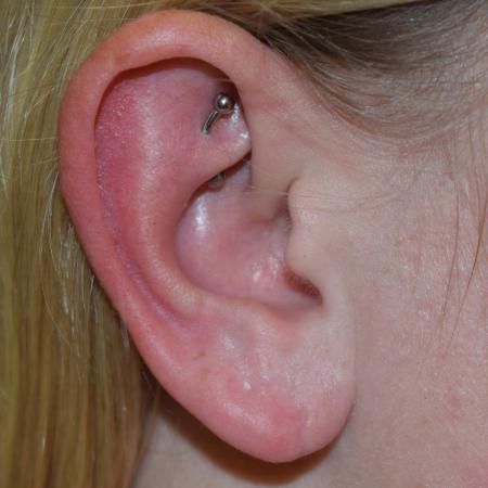 After image 1 Case #105246 - Earlobe Repair