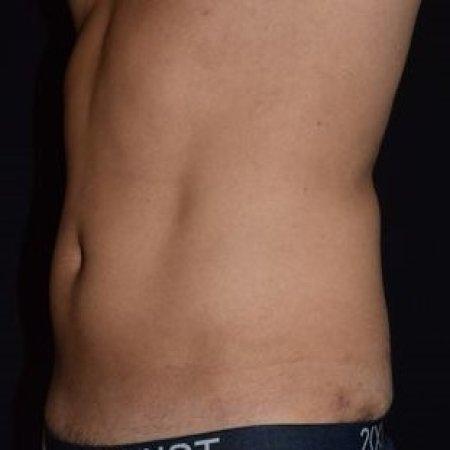 Before image 3 Case #105266 - Male Liposuction
