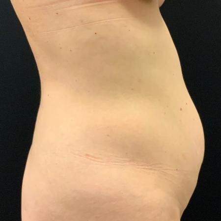 Before image 4 Case #105241 - Mini Abdominoplasty with Liposuction